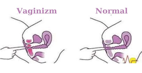 Niyə cinsi əlaqə mümkün olmur?